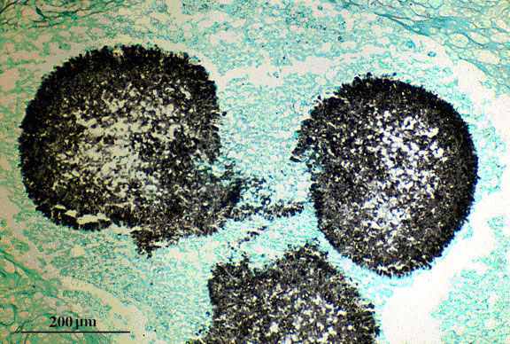 Grocott’s methenamine silver (Giemsa - GMS) stained tissue section of lung showing fungal balls of hyphae ofAspergillus fumigates (aspergilloma)