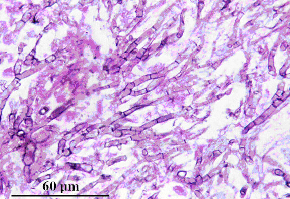 Grocott’s methenamine silver (GMS) stained tissue section of lung showing dichotomously  branched, septate hyphae of Aspergillus fumigatus