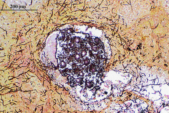 Grocott’s methenamine silver (Giemsa - GMS) stained tissue sections showing Aspergillus fumigatus in lung tissue; note conidial heads forming in an alveolus.