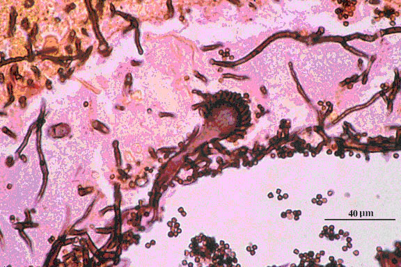 Grocott’s methenamine silver (Giemsa - GMS) stained tissue sections showing Aspergillus fumigatus in lung tissue; note conidial heads forming in an alveolus.