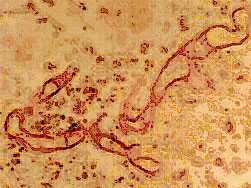 A lung section showing large hyphal elements {1879}