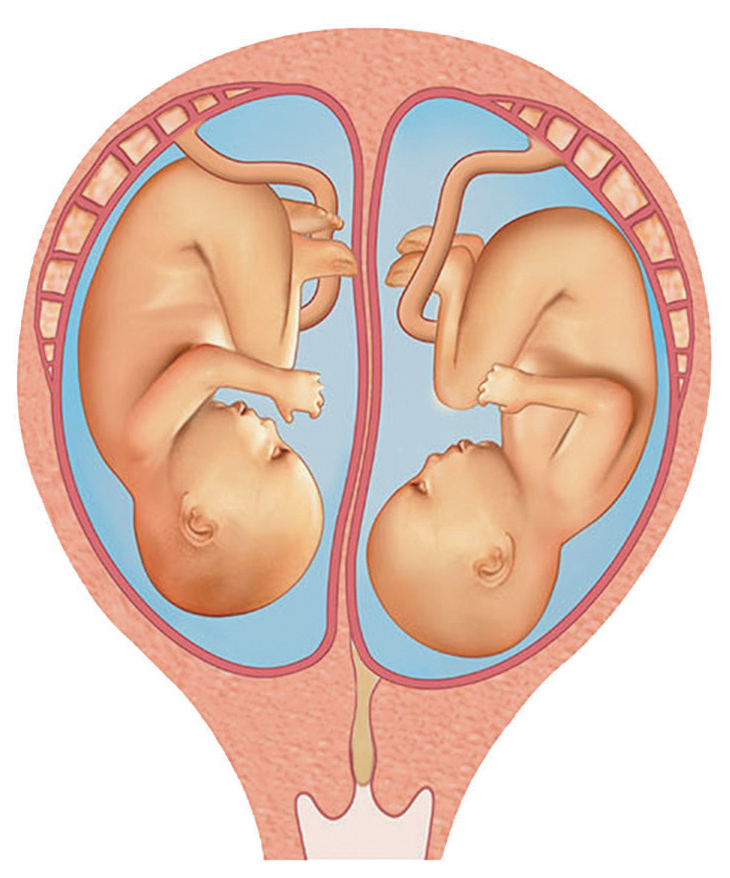 Les jumeaux non identiques ont chacun un placenta.